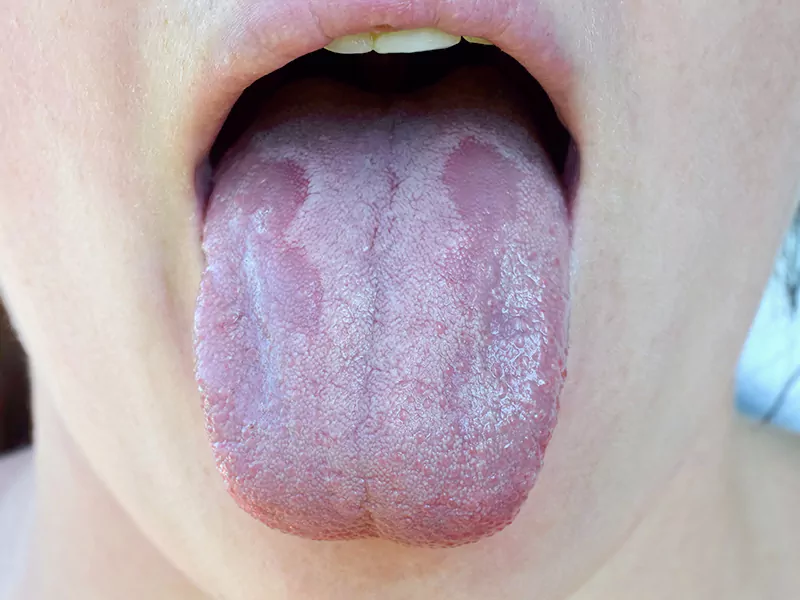 Oral thrush