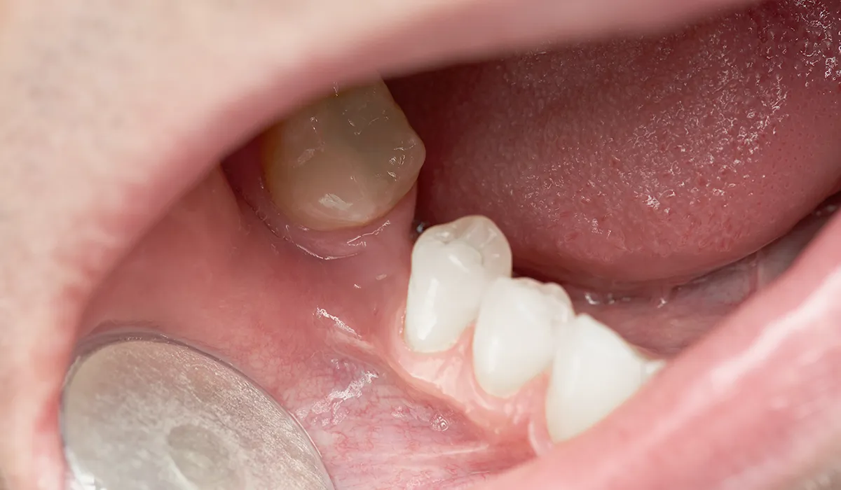 teeth gap teeth gap